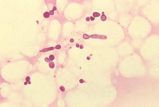 Malassezia furfur - groźny pasożyt, niszczący cebulki włosów